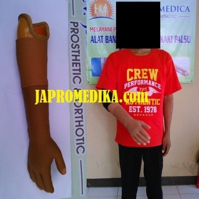 tangan_palsu_bawah_siku_0