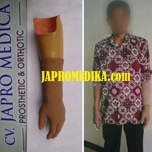 tangan_palsu_bawah_siku_ponorogo1